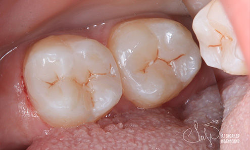 Эстетическая стоматология - фото после
