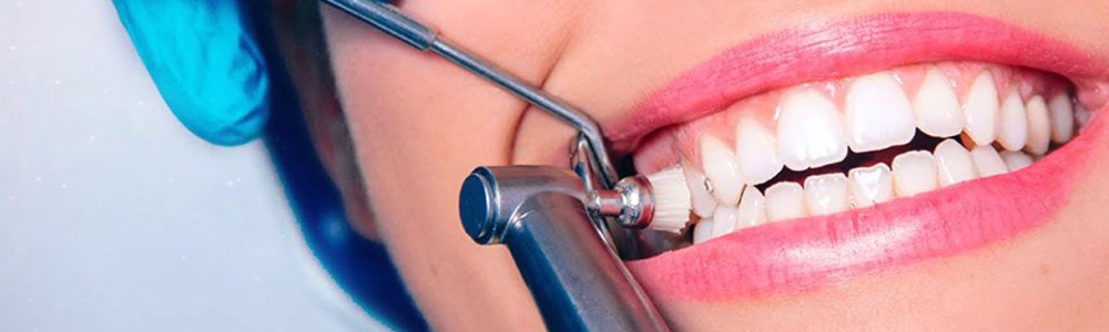 Стоматолог удалит зубной налет и камень - фото