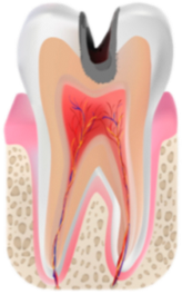 Глубокий кариес