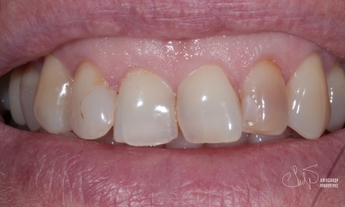 Эстетическая стоматология - фото до