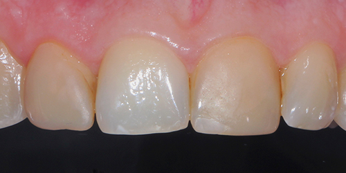 Эстетическая стоматология - фото до