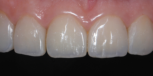 Эстетическая стоматология - фото после