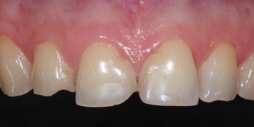 Эстетическая стоматология - фото до