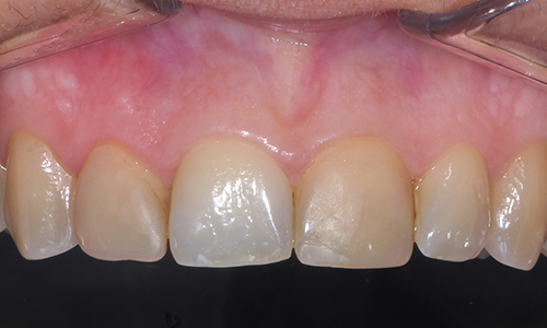 Эстетическая стоматология - фото до