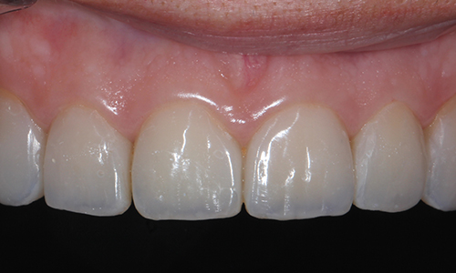 Эстетическая стоматология - фото после