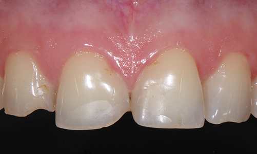 Эстетическая стоматология - фото до