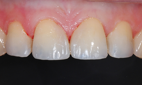 Эстетическая стоматология - фото после