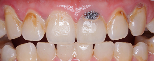 Эстетическая стоматология - фото до