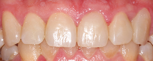 Эстетическая стоматология - фото после