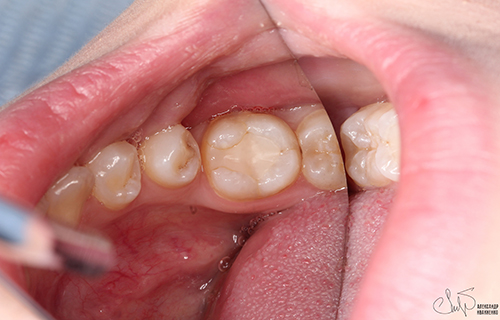 Эстетическая стоматология - фото до