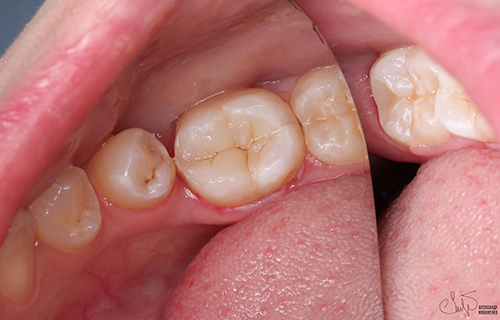 Эстетическая стоматология - фото после