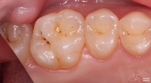 Эстетическая стоматология - фото до