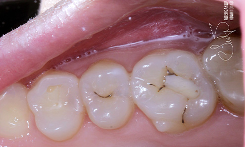 Эстетическая стоматология - фото до