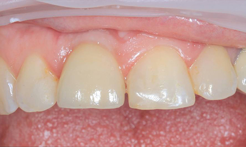 Эстетическая стоматология - фото после